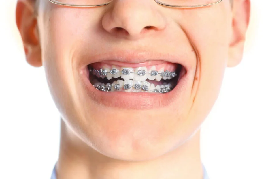 Early Orthodontics – When is it Necessary?